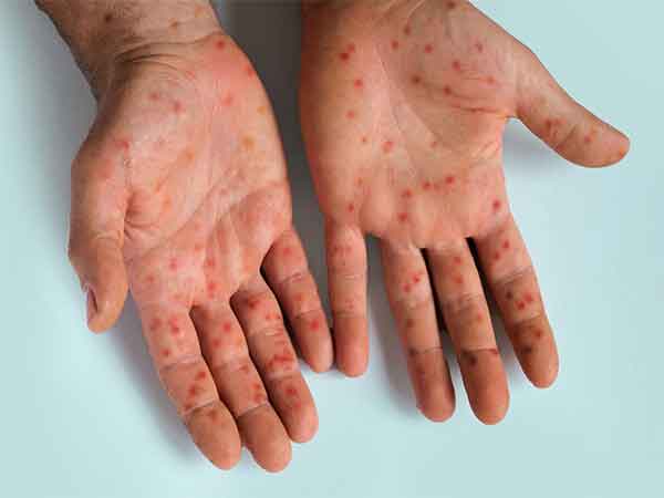 CDC reports 11 Measles outbreaks Nationwide, Urges vaccination